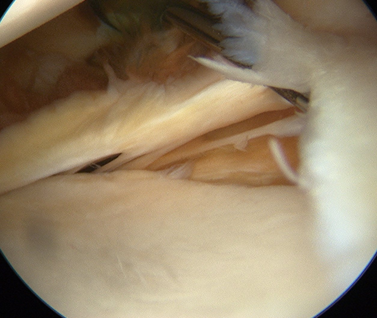 Shoulder Sublabral foramen